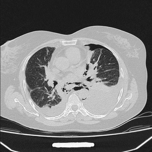 Boerhaave syndrome (Radiopaedia 45644-49799 Axial lung window 64).jpg