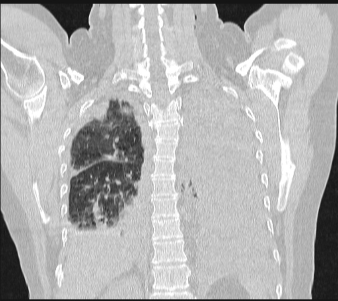 Boerhaave syndrome (Radiopaedia 45644-49799 Coronal lung window 51).jpg