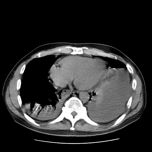 Boerhaave syndrome (Radiopaedia 59796-67310 Axial liver window 45).jpg