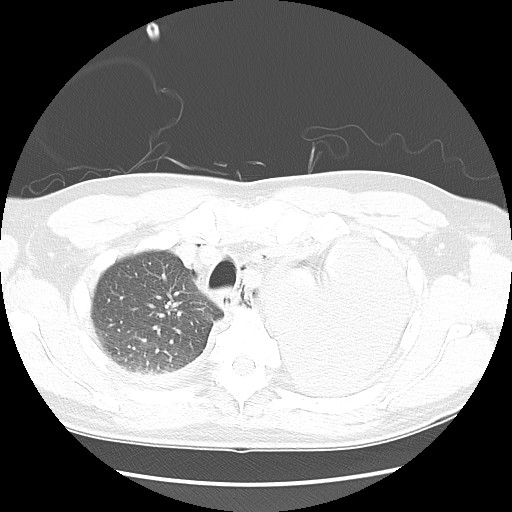 Boerhaave syndrome (Radiopaedia 59796-67310 Axial lung window 17).jpg