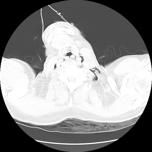 Boerhaave syndrome (Radiopaedia 59796-67310 Axial lung window 3).jpg