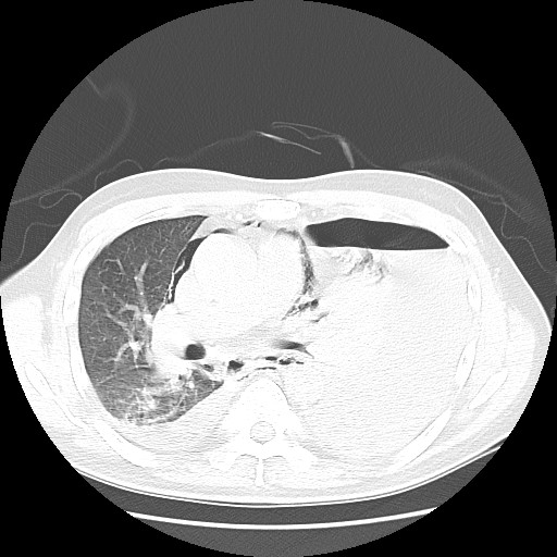 Boerhaave syndrome (Radiopaedia 59796-67310 Axial lung window 31).jpg
