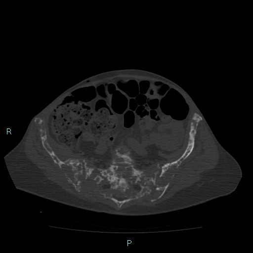 Bone metastases from untreated breast cancer (Radiopaedia 42973-46219 Axial bone window 153).jpg