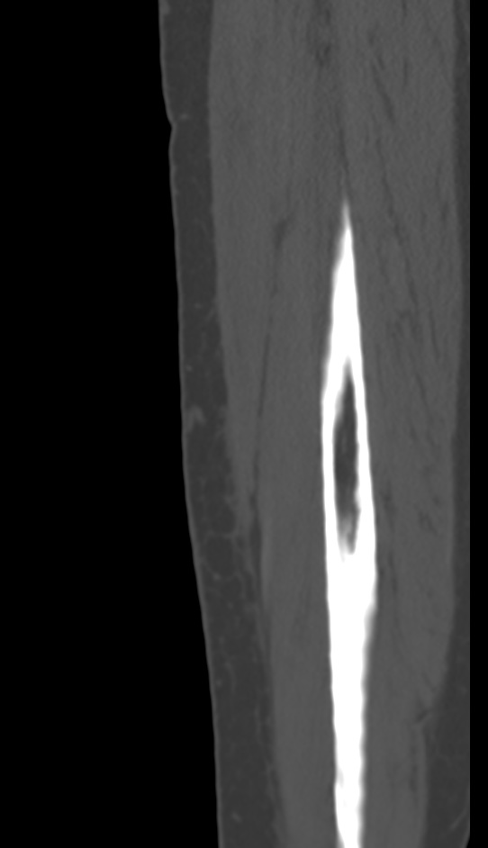 Bone metastasis - tibia (Radiopaedia 57665-64609 Sagittal bone window 165).jpg