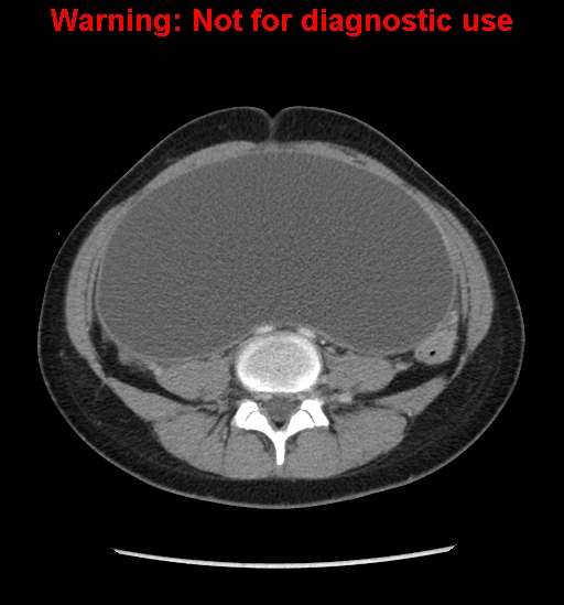Borderline mucinous cystadenoma of ovary (Radiopaedia 25586-25767 A 53).jpg