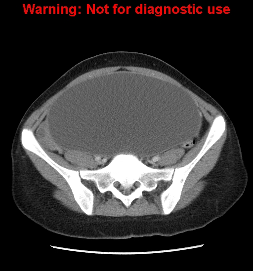 Borderline mucinous cystadenoma of ovary (Radiopaedia 25586-25767 A 71).jpg