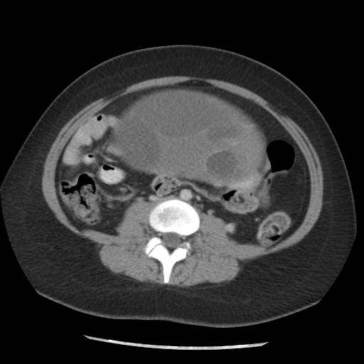 File:Borderline mucinous tumor (ovary) (Radiopaedia 78228-90808 A 96).jpg