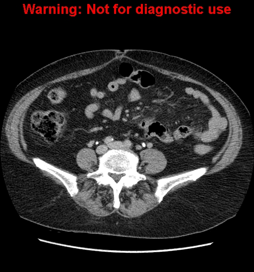 File:Bosniak renal cyst - type II (Radiopaedia 23404-23468 F 40).jpg