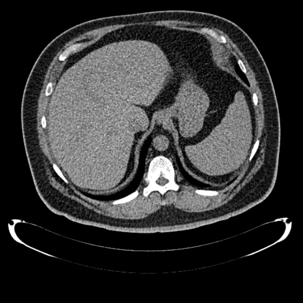 Bosniak renal cyst - type IV (Radiopaedia 24244-24518 Axial non-contrast 77).jpg