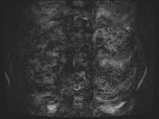 Bouveret syndrome (Radiopaedia 61017-68856 Axial MRCP 1).jpg