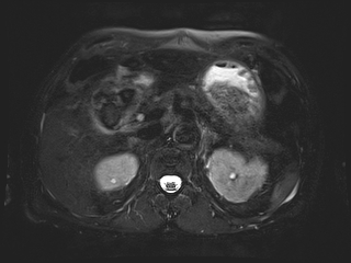 File:Bouveret syndrome (Radiopaedia 61017-68856 Axial MRCP 22).jpg