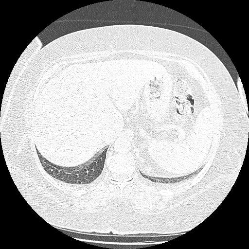 Bovine aortic arch - right internal mammary vein drains into the superior vena cava (Radiopaedia 63296-71875 Axial lung window 166).jpg