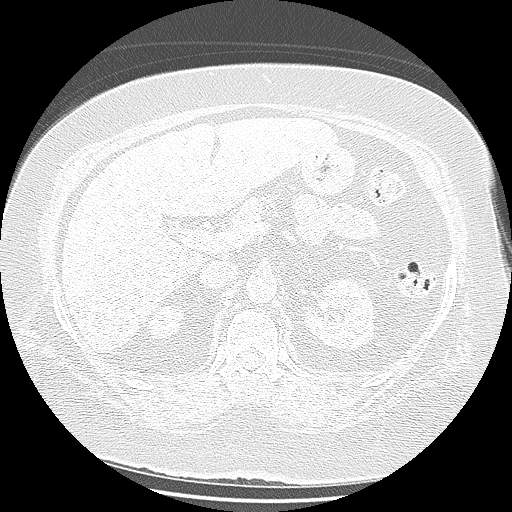 Bovine aortic arch - right internal mammary vein drains into the superior vena cava (Radiopaedia 63296-71875 Axial lung window 197).jpg