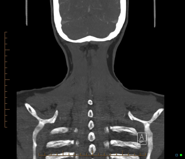 Brachiocephalic trunk stenosis (Radiopaedia 87242-103519 B 65).jpg