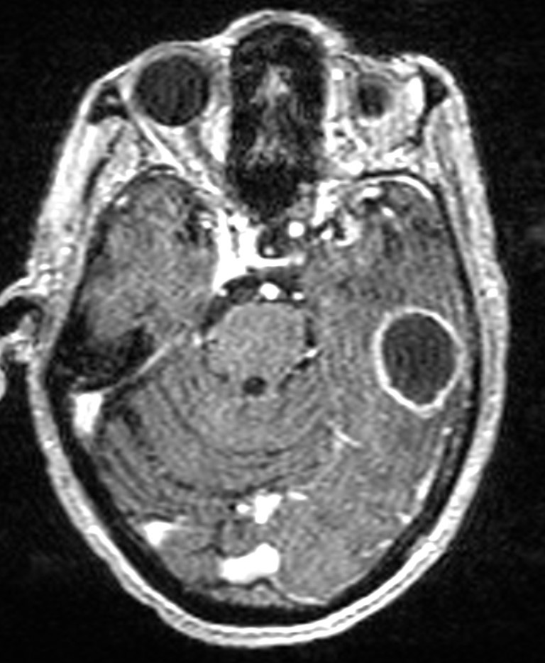 Brain abscess with dual rim sign (Radiopaedia 87566-103938 Axial T1 C+ 58).jpg