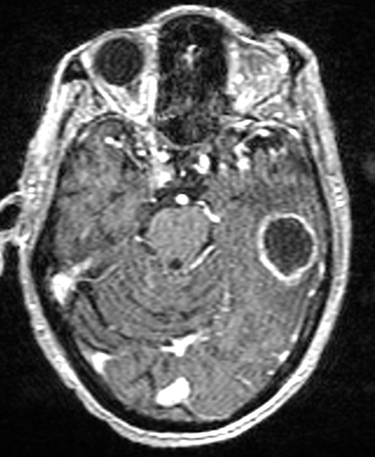 Brain abscess with dual rim sign (Radiopaedia 87566-103938 Axial T1 C+ 60).jpg