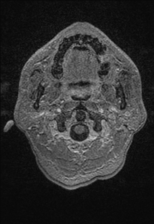 Brain abscess with ventriculitis (Radiopaedia 85703-101495 Axial T1 C+ 6).jpg