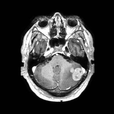 File:Brain metastases from lung cancer (Radiopaedia 83839-99028 Axial T1 C+ 12).jpg