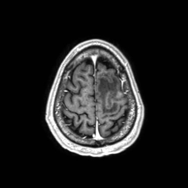 File:Brain metastases from lung cancer (Radiopaedia 83839-99028 Axial T1 C+ 60).jpg
