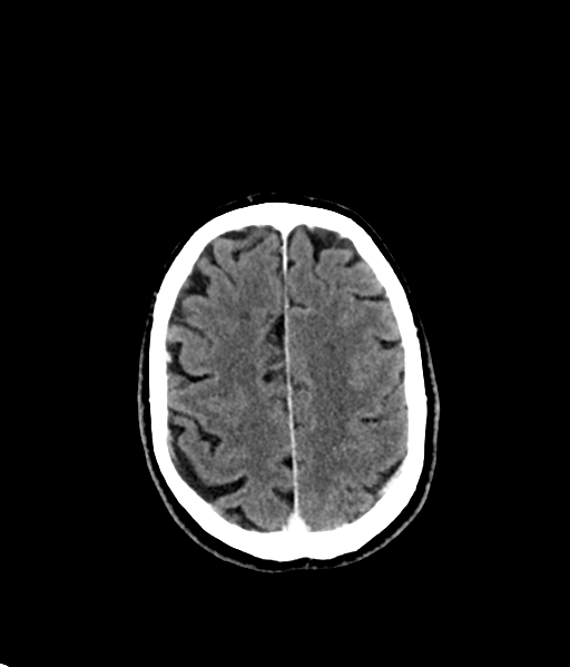 File:Brain metastasis (large cystic mass) (Radiopaedia 47497-52106 Axial C+ 46).png