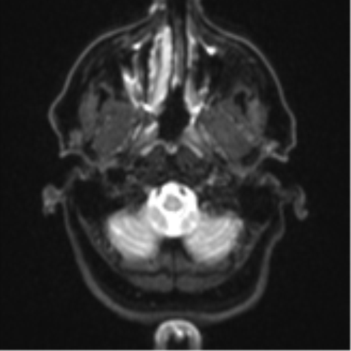 Brain metastasis (large cystic mass) (Radiopaedia 47497-52107 Axial DWI 2).png