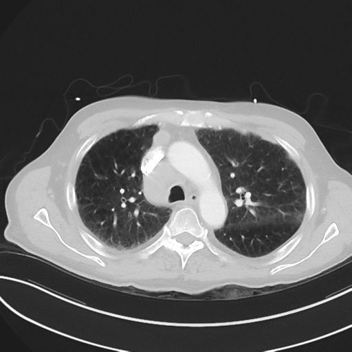 File:Brain metastasis (lung cancer) (Radiopaedia 48289-53180 Axial lung window 21).png
