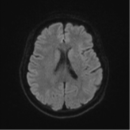 Brain metastasis (sarcoma) (Radiopaedia 47576-52209 Axial DWI 44).png