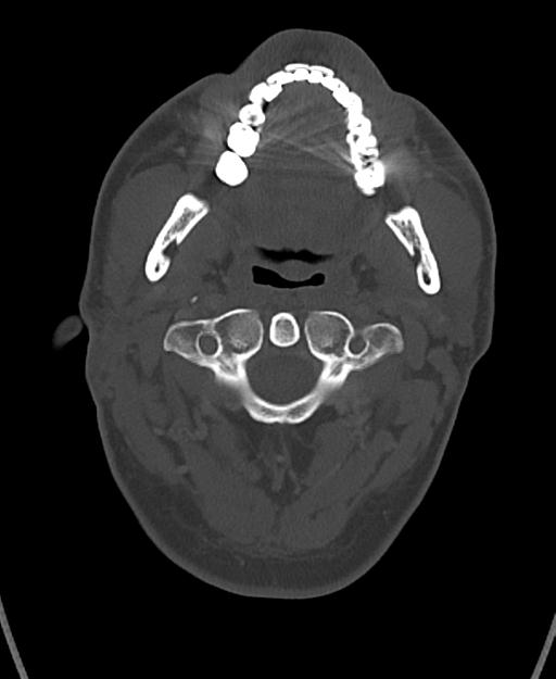 Branchial cleft cyst (Radiopaedia 31167-31875 Axial bone window 20).jpg
