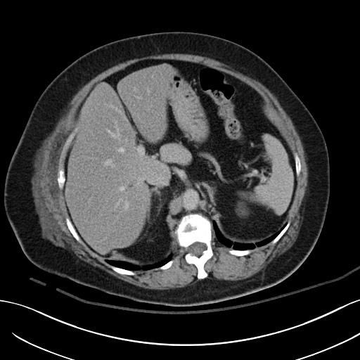 Breast carcinoma with pathological hip fracture (Radiopaedia 60314-67974 B 17).jpg