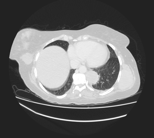 Breast metastases from facial malignant melanoma (Radiopaedia 60316-67975 Axial lung window 86).jpg