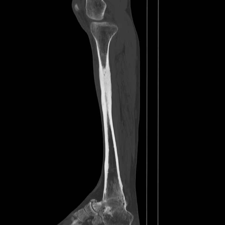 Brodie abscess - tibia (Radiopaedia 66028-75204 Sagittal bone window 24).jpg