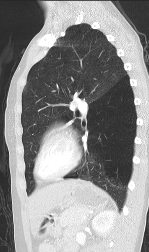 Bronchial atresia (Radiopaedia 73677-84470 Sagittal lung window 35).jpg