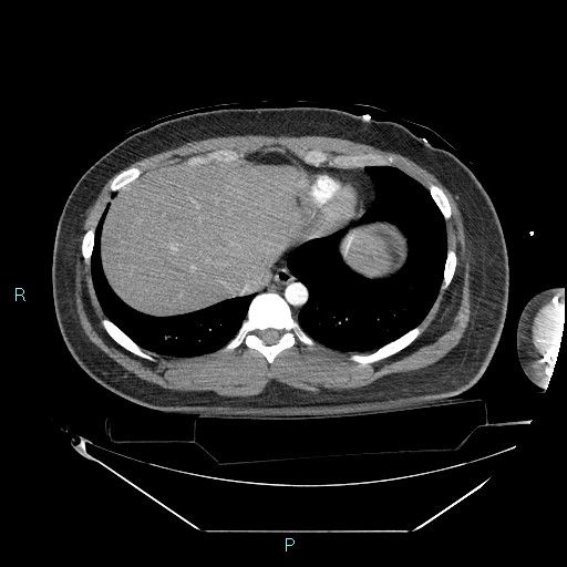 Bronchial carcinoid tumor (Radiopaedia 78272-90870 B 97).jpg