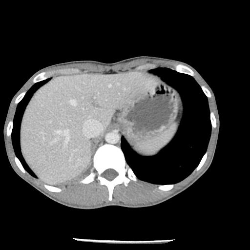 File:Bronchial carcinoid tumor causing right lower lobe collapse (Radiopaedia 83495-98594 A 50).jpg