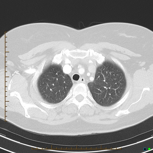 File:Bronchial diverticula (Radiopaedia 79512-92675 Axial lung window 10).jpg