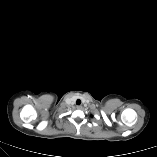 Bronchial mucoepidermoid carcinoma (Radiopaedia 57023-63895 Axial 8).jpg