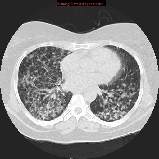 File:Bronchoalveolar carcinoma (Radiopaedia 13224-13233 Axial lung window 27).jpg