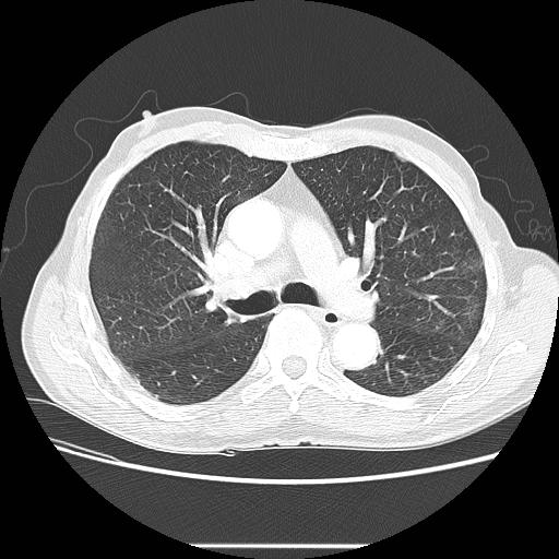 Bronchocele (Radiopaedia 17097-16795 Axial lung window 51).jpg