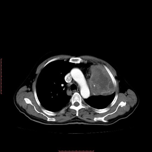 File:Bronchogenic carcinoma with left atrial large deposit - T4N3M1a (Radiopaedia 42316-45428 A 11).jpg