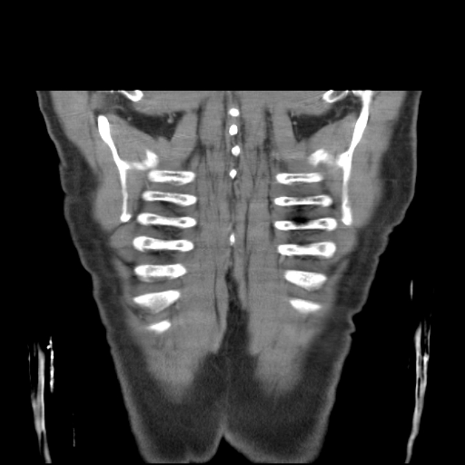 Bronchogenic carcinoma with upper lobe collapse (Radiopaedia 29297-29726 D 52).jpg