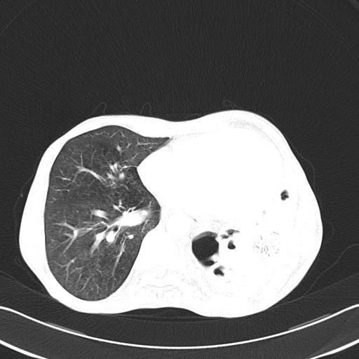 Bronchopleural fistula secondary to tuberculosis (Radiopaedia 20415-20322 Axial lung window 37).jpg