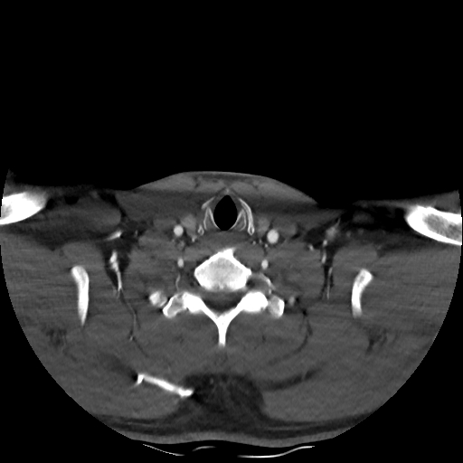 Buccal fat pad arteriovenous malformation (Radiopaedia 70936-81144 A 87).jpg