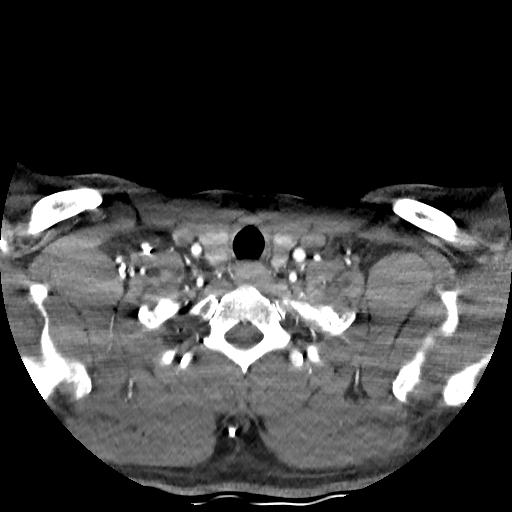 Buccal fat pad arteriovenous malformation (Radiopaedia 70936-81144 D 57).jpg