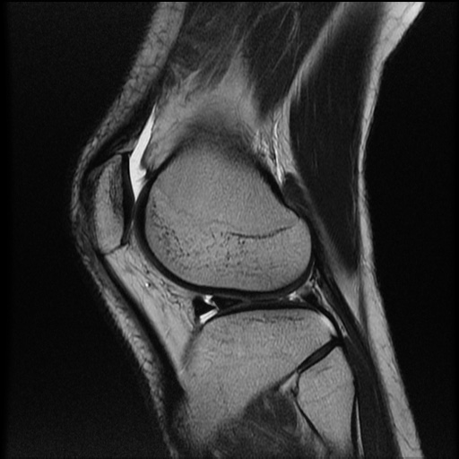 File:Bucket-handle meniscus tear (Radiopaedia 65700-74809 Sagittal T2 19).jpg