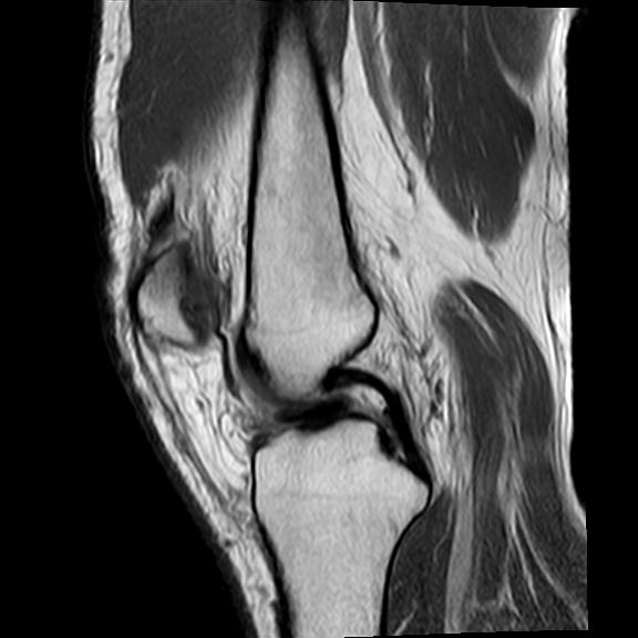 File:Bucket handle tear - medial meniscus (Radiopaedia 29250-29664 Sagittal PD 12).jpg