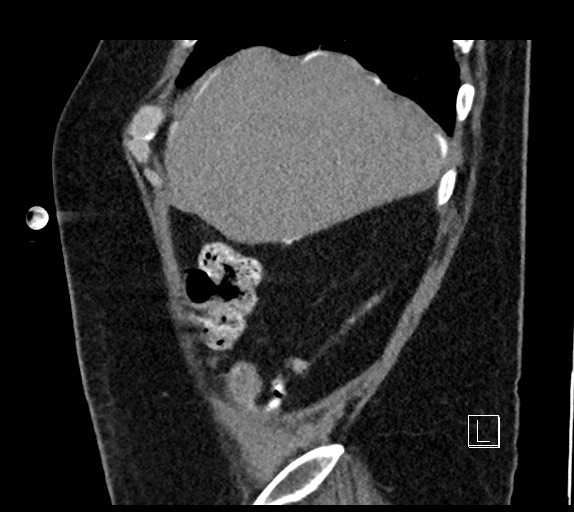 Buried bumper syndrome - gastrostomy tube (Radiopaedia 63843-72577 Sagittal Inject 103).jpg