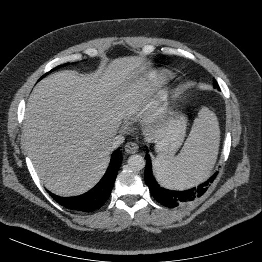 Burned-out testicular seminoma - retroperitoneal nodal metastases (Radiopaedia 62872-71245 A 10).jpg