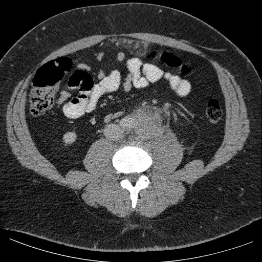 Burned-out testicular seminoma - retroperitoneal nodal metastases (Radiopaedia 62872-71245 A 43).jpg