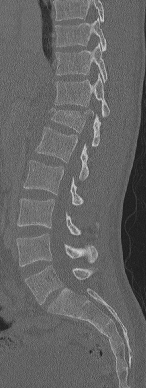 Burst fracture - T12 with conus compression (Radiopaedia 56825-63647 Sagittal bone window 47).png
