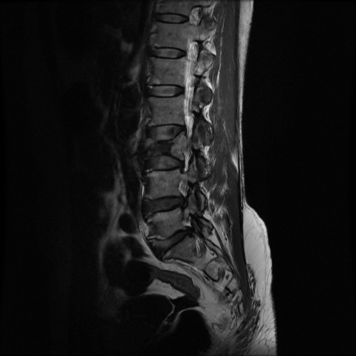 File:Burst fracture - lumbar spine (Radiopaedia 72877-83541 Sagittal T2 3).jpg